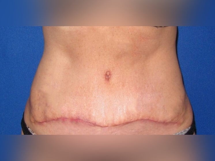 Tummy Tuck After