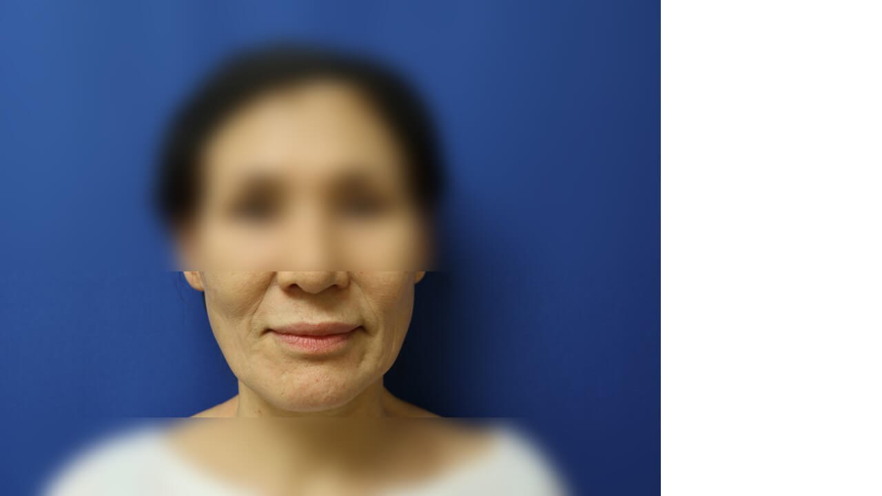Skin Rejuvenation Treatment Before