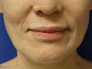 Skin Rejuvenation Treatment Before