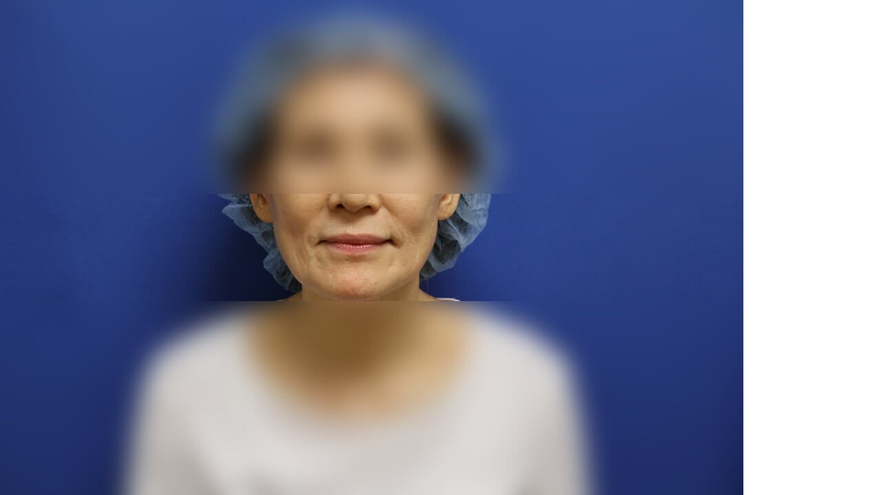 Skin Rejuvenation Treatment After