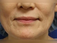 Skin Rejuvenation Treatment After