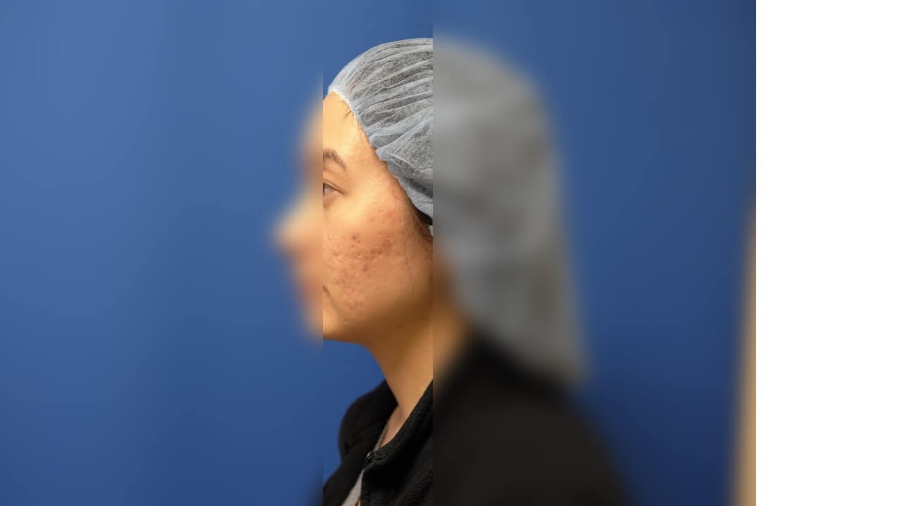 Infini Radio Frequency Laser Before