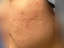 Infini Radio Frequency Laser Before