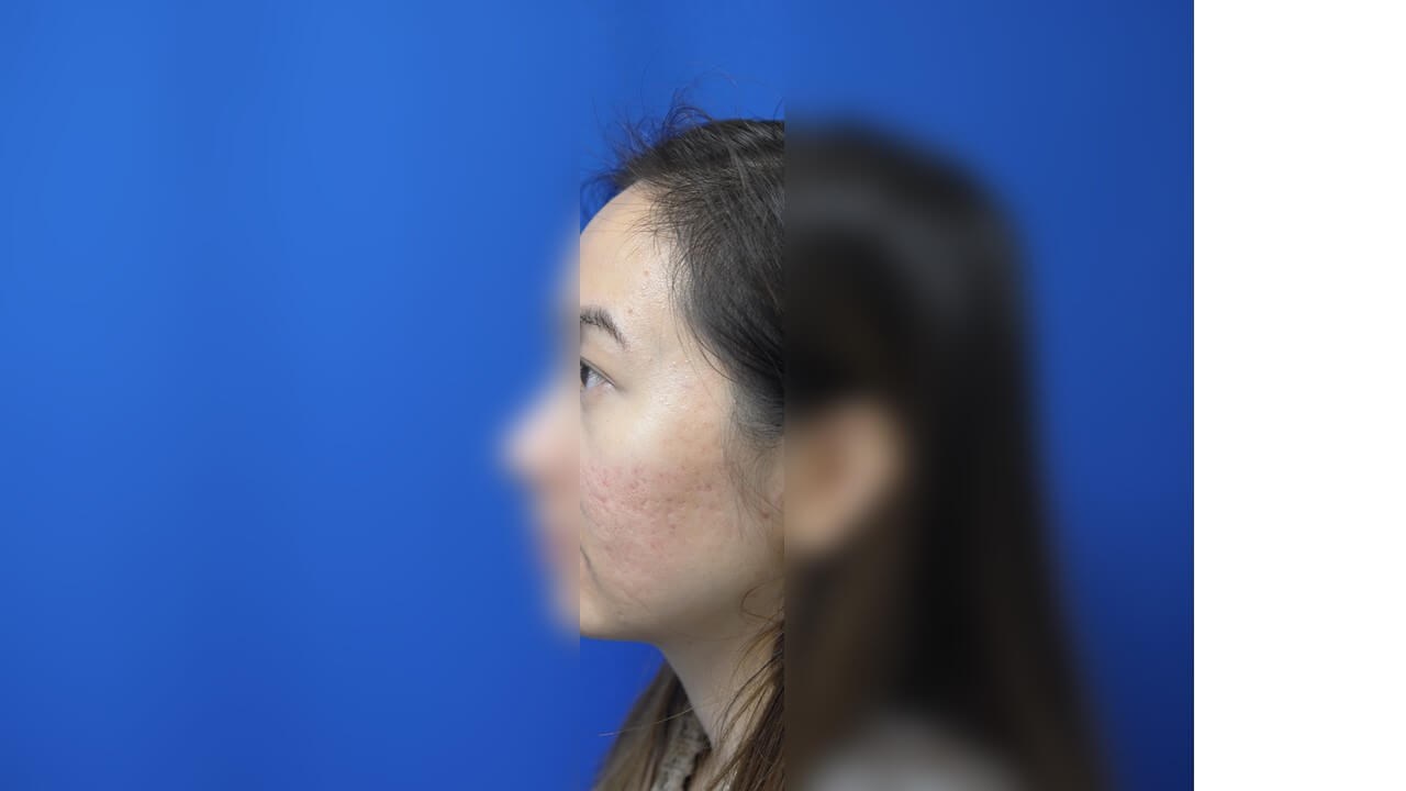 Infini Radio Frequency Laser After