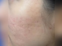 Infini Radio Frequency Laser After