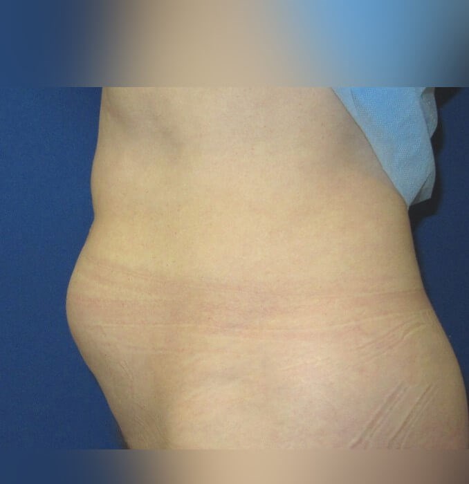 Liposuction Before