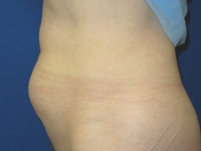 Liposuction Before
