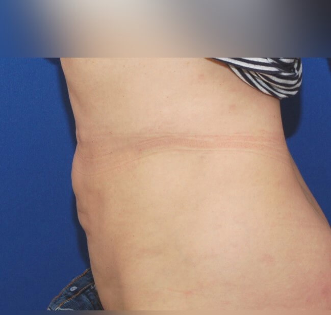 Liposuction After
