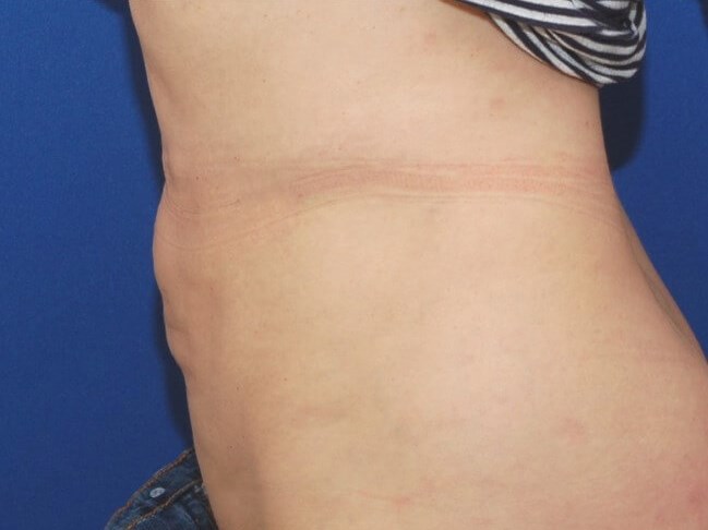 Liposuction After