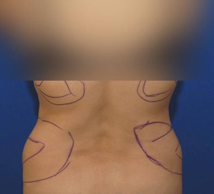 Liposuction Before