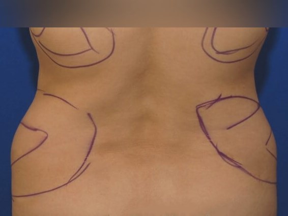 Liposuction Before