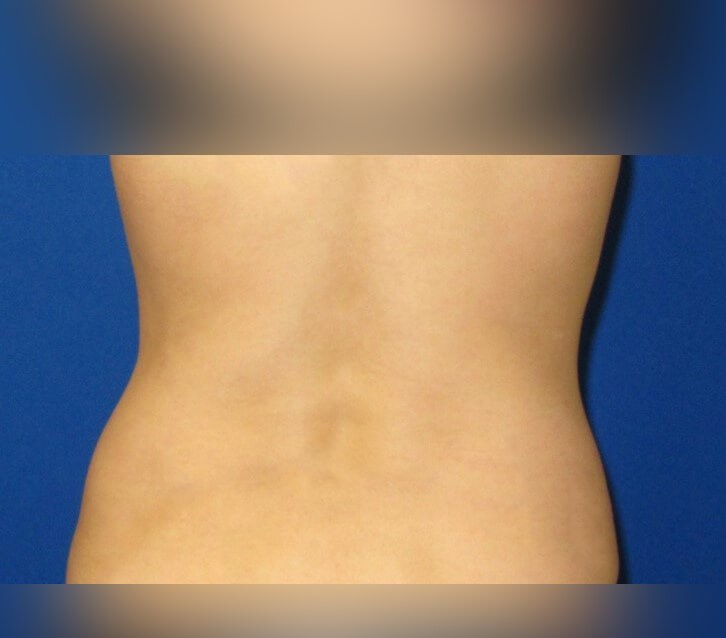 Liposuction After