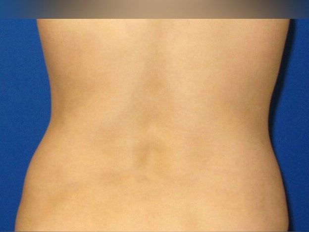 Liposuction After