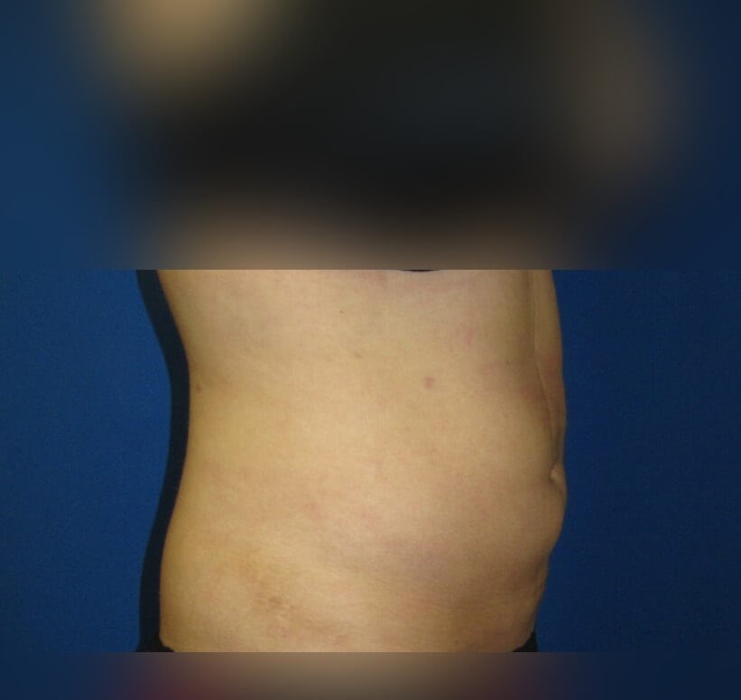 Liposuction After