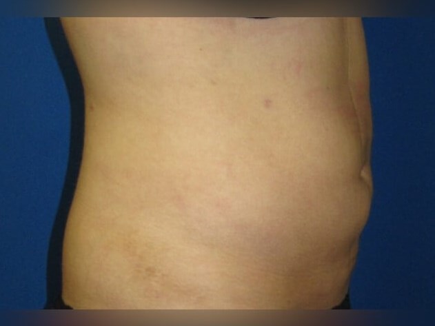 Liposuction After
