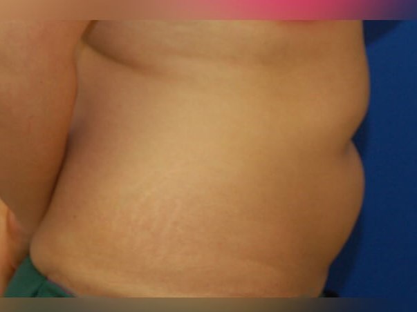 Liposuction Before