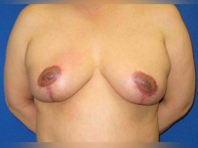 Breast Lift After
