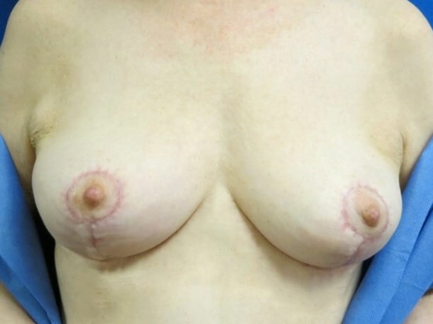 Breast Lift After