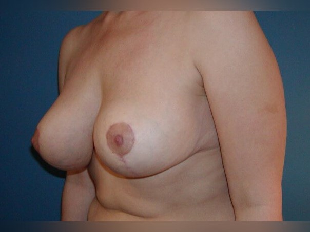 Breast Lift After