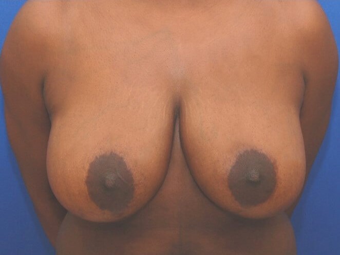 Breast Lift Before