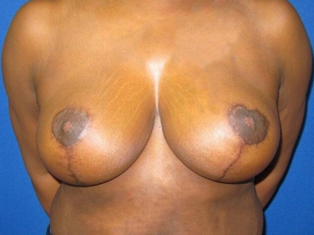 Breast Lift After
