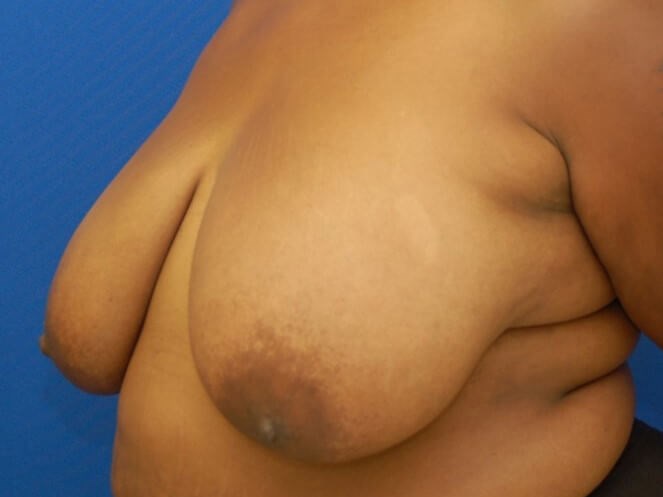 Breast Lift Before