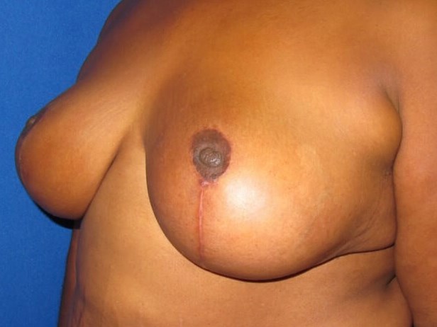 Breast Lift After